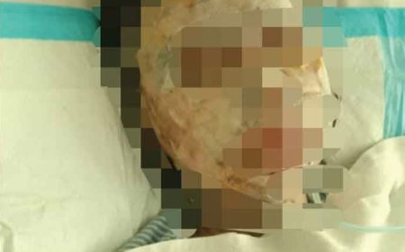 Gadis remaja parah muka disimbah asid